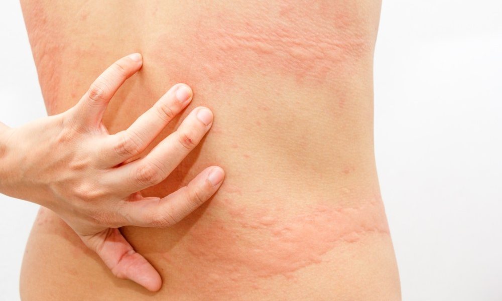 Como Evitar A Alergia Na Pele Como Posso Prevenir Os Sintomas 7012